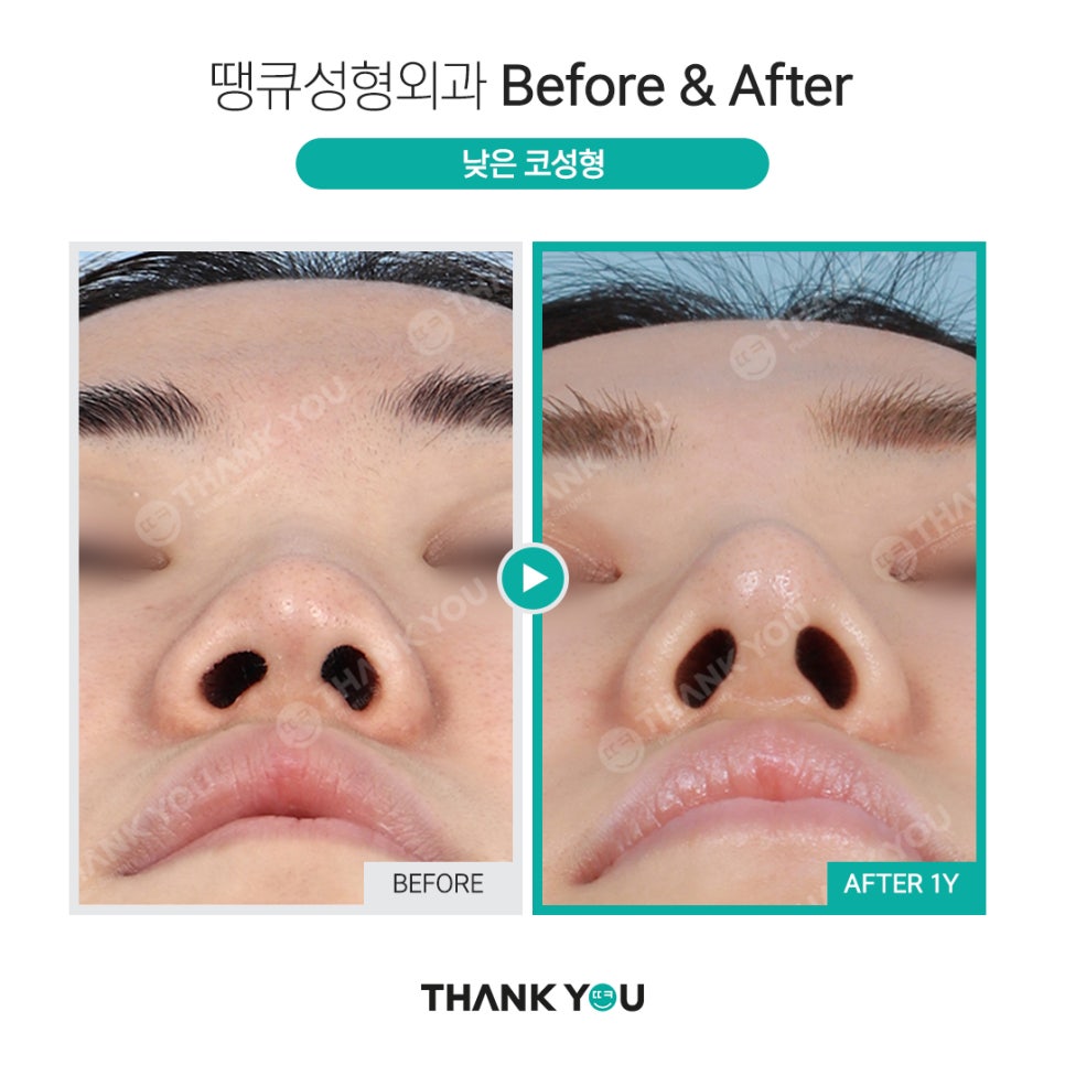 코성형 실리콘 비침, 코낮추기 재수술로 매끈하게 관련 이미지 22