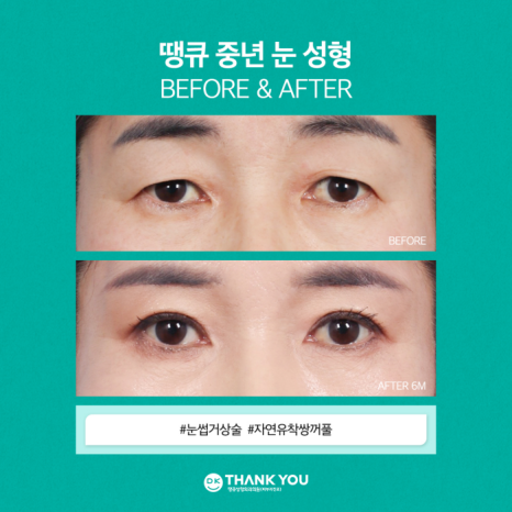 눈썹거상술 & 자연유착쌍꺼풀로 처진 눈꺼풀 효과적으로 개선! 관련 이미지 5