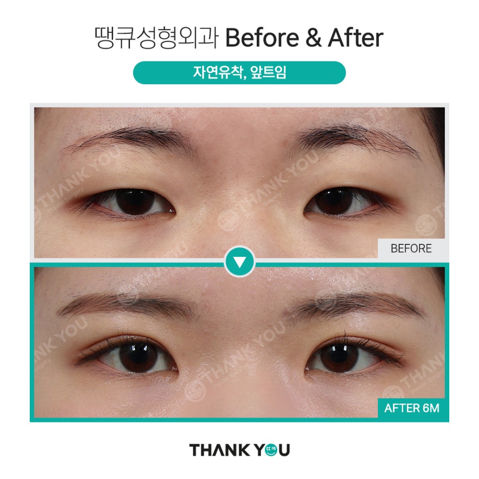 쌍수 뒷트임 (앞트임,밑트임, 듀얼트임 종류) 전후사진 관련 이미지 4