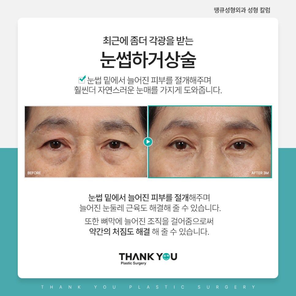 쌍꺼풀수술 없이 처진 눈 해결? [중년 이마거상/ 눈썹하거상술] 관련 이미지 2