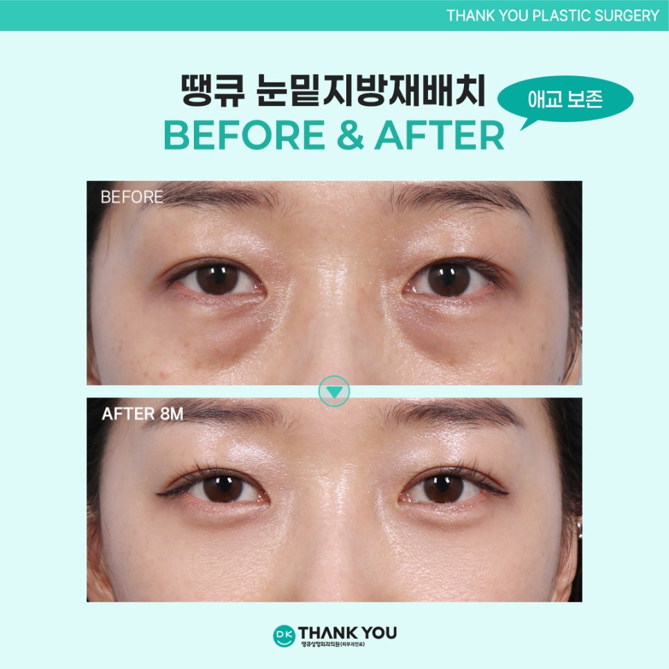 눈밑지방재배치효과? 수술 잘하는 곳 땡큐에서 확인! 관련 이미지 10
