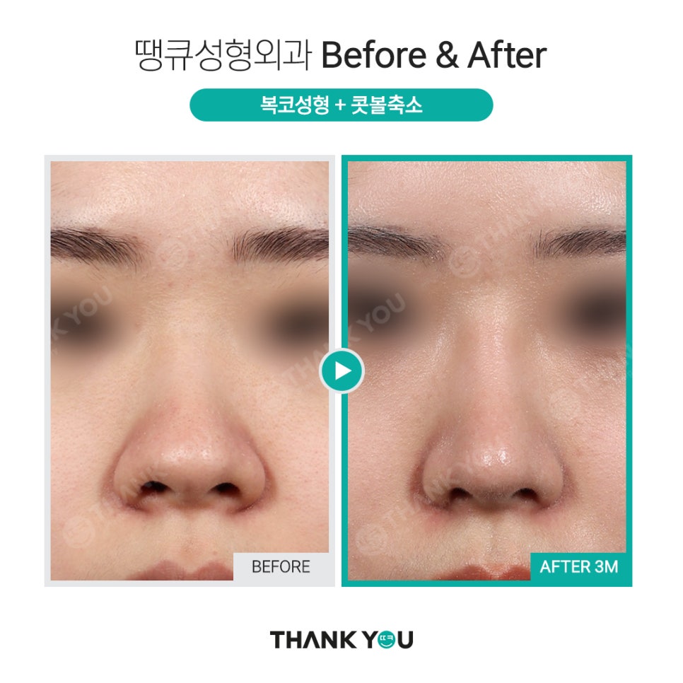 코 재수술시 기존 실리콘은 꼭 제거해야 되나요? 관련 이미지 13