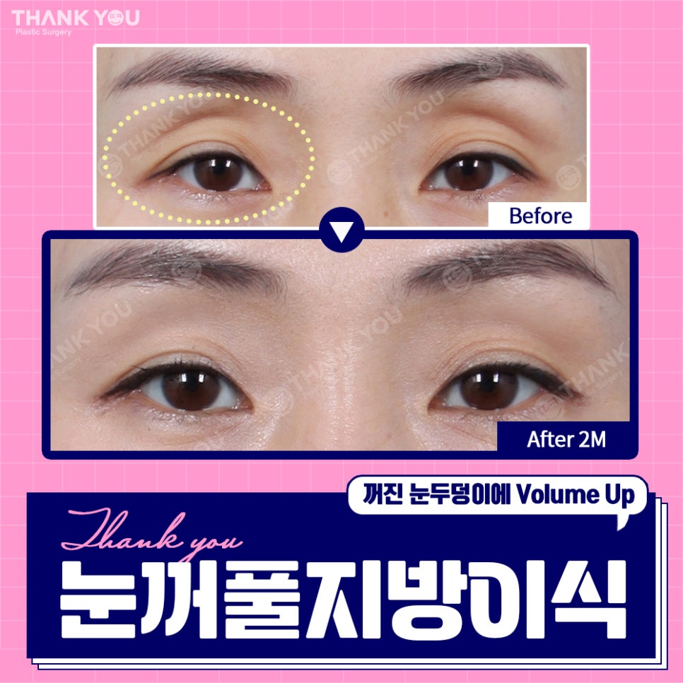 눈꺼짐? Thank You눈꺼풀 지방이식으로 볼륨UP 관련 이미지 1