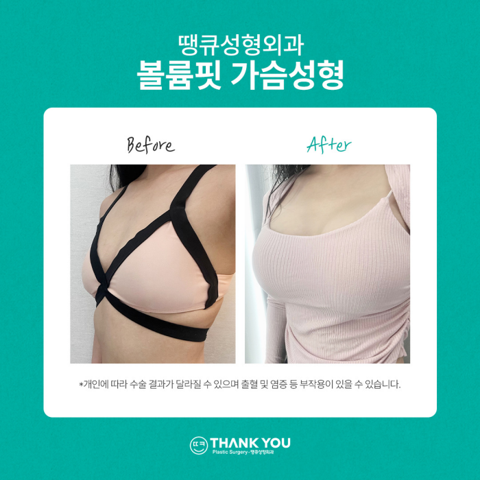 땡큐성형외과 가슴성형 이벤트✨ 관련 이미지 10