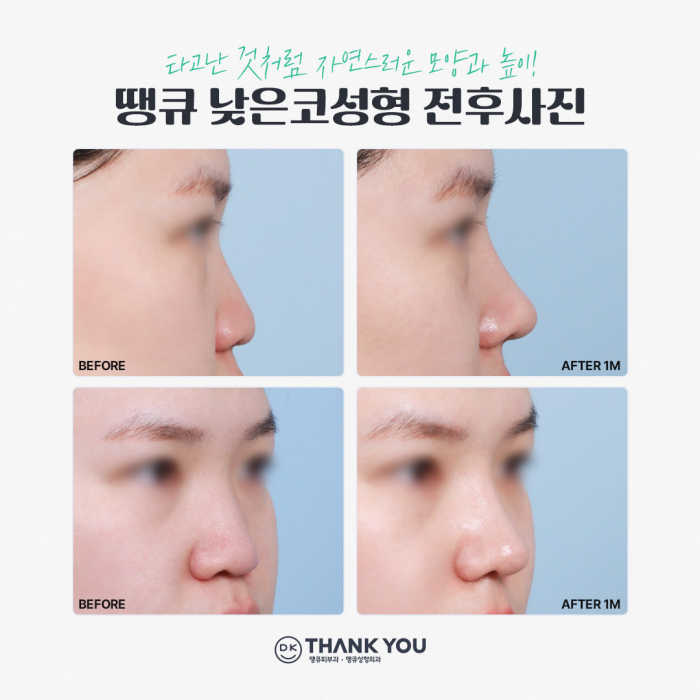 낮은코성형 내게 맞는 높이와 모양으로 관련 이미지 2