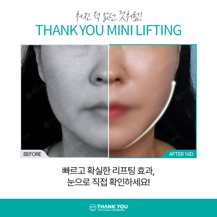 미니리프팅, 탄력과 주름을 동시에 개선하는 동안시술🤗 관련 이미지 7