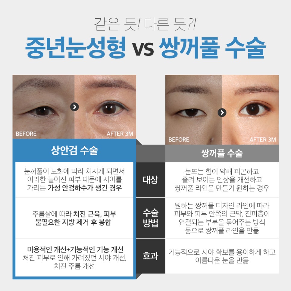 중년눈수술, 50대 60대 눈처짐과 눈꺼풀짓무름 해결법 관련 이미지 6