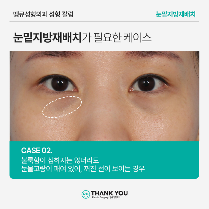 눈밑지방재배치병원에서 알려주는 수술이 필요한 케이스 관련 이미지 5