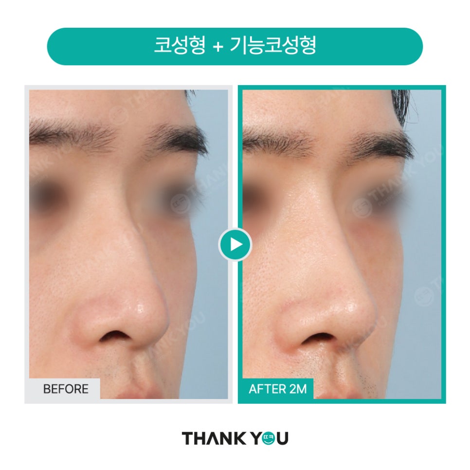 신논현역 성형외과, 남자 휜코성형, 매부리코 성공 포인트는? 관련 이미지 13
