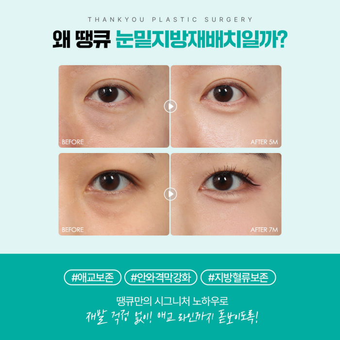 광일병 in 땡큐성형외과 ✨ 눈밑지 & 다크서클 편 공개 관련 이미지 8