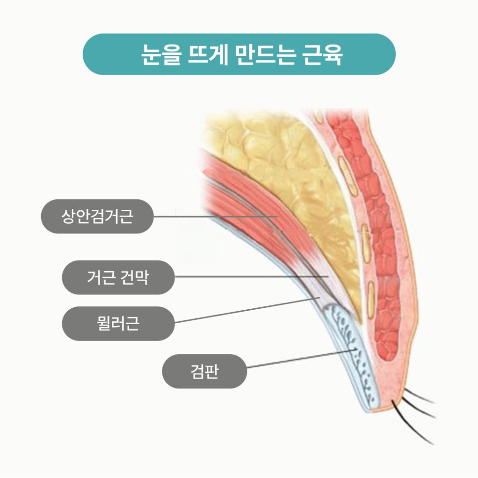 안검하수에 필요한 눈매교정 (ft.전후사진 체크) 관련 이미지 3