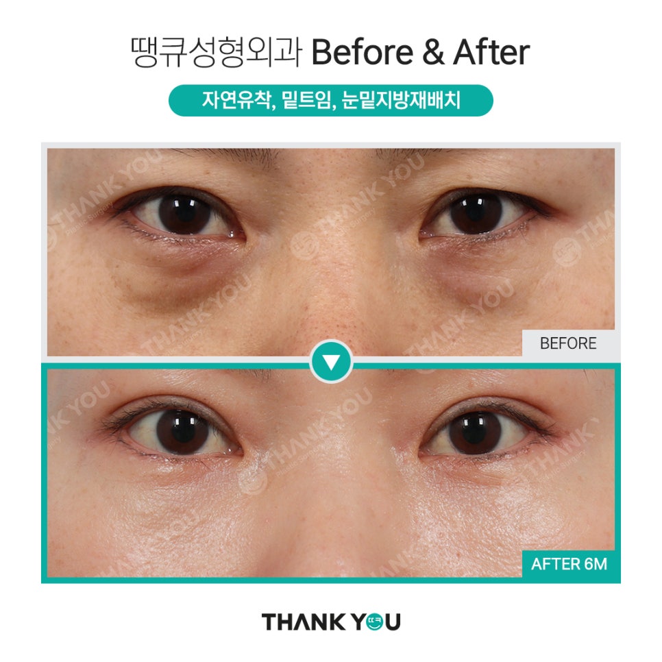 하안검과 눈밑지방재배치의 차이점? 관련 이미지 10