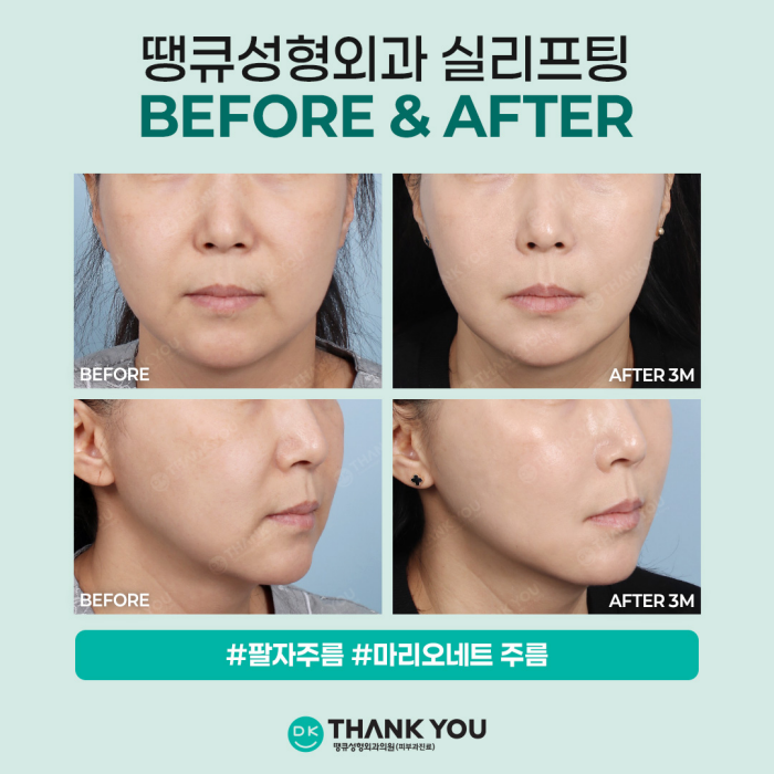 If You Want to Create a Noticeable Difference Before and After Face Thread Lifting image 8