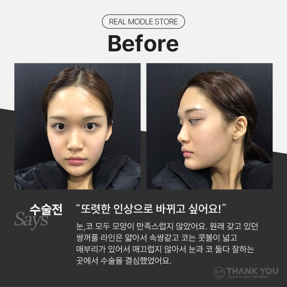 눈코성형 같이 하고싶다면? (자연유착 윗트임+콧불축소) 관련 이미지 2