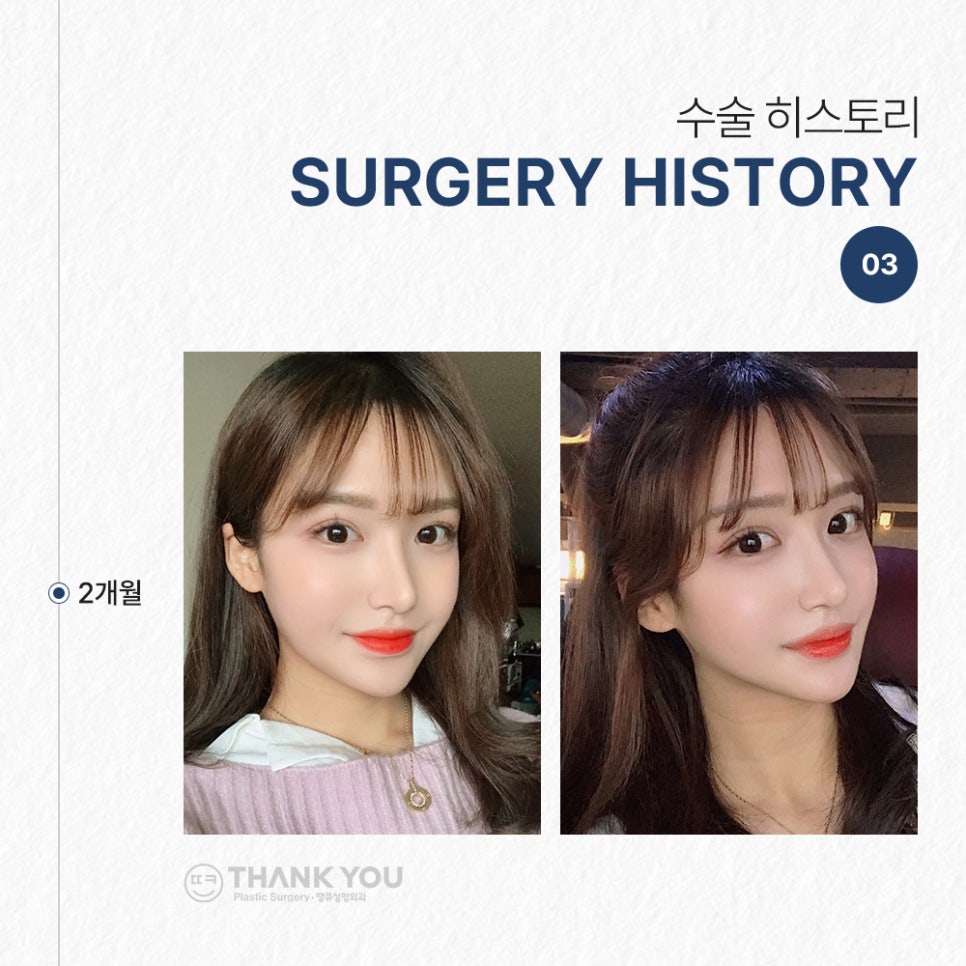 눈코성형 같이 하고싶다면? (자연유착 윗트임+콧불축소) 관련 이미지 7