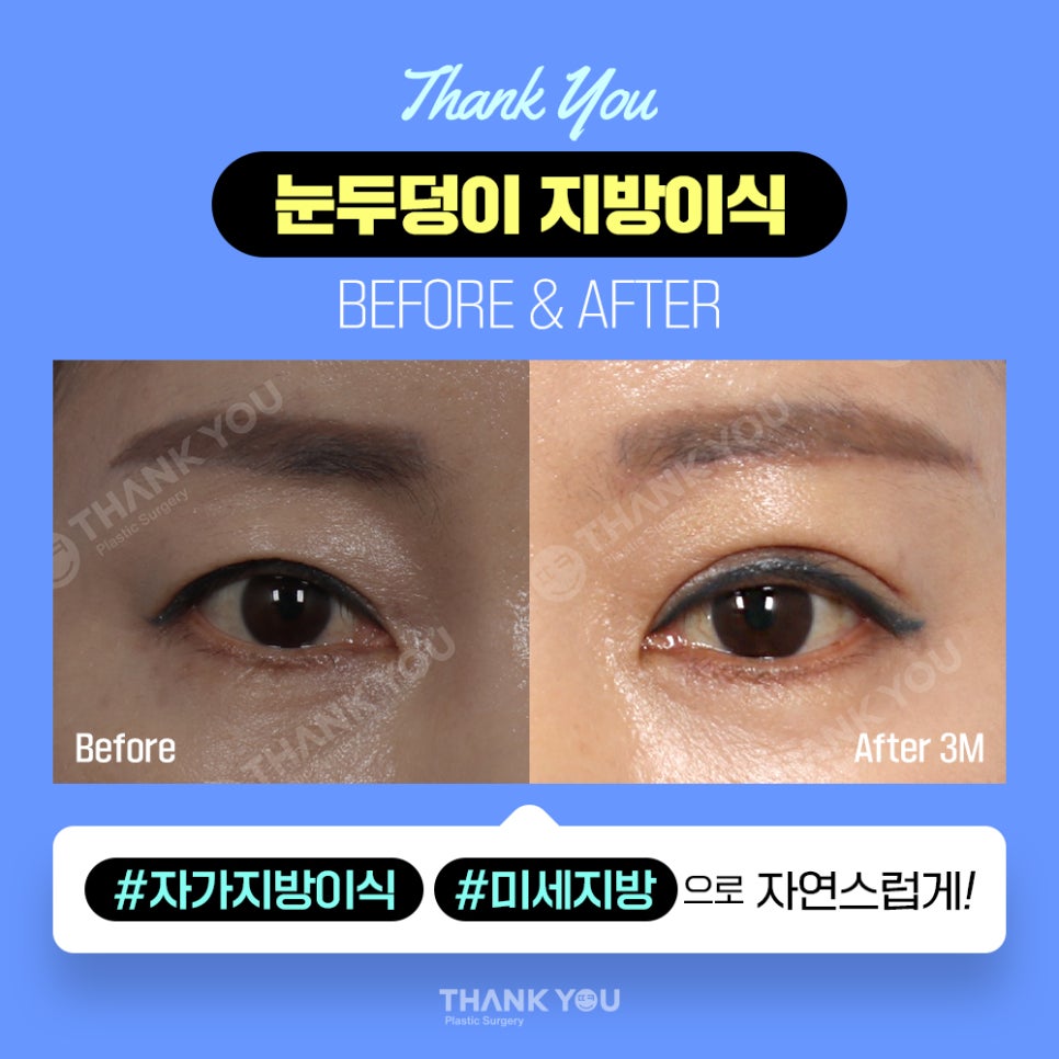 눈두덩이 지방이식, 푹꺼진 눈꺼풀에 자가지방이식으로 관련 이미지 13