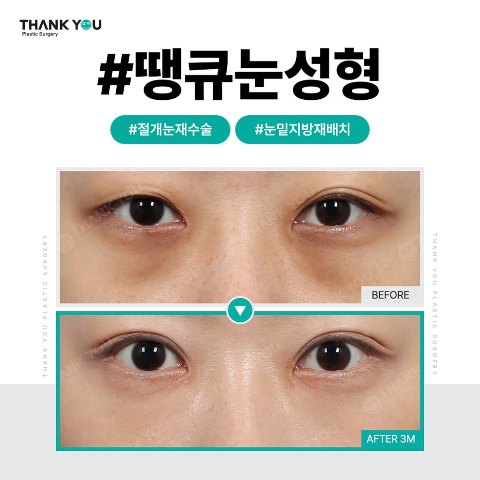 쌍꺼풀 라인 종류, 내게 맞는 쌍수랑 트임은?(인라인) 관련 이미지 6