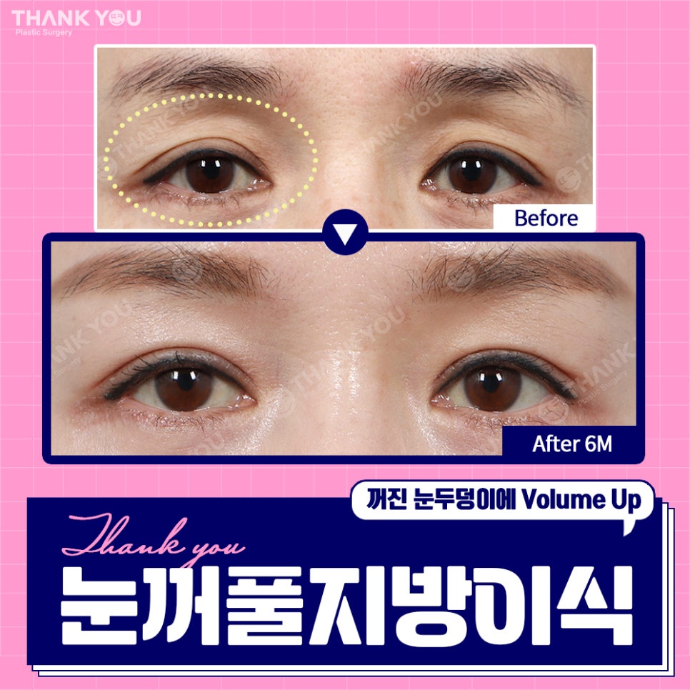 눈꺼짐? Thank You눈꺼풀 지방이식으로 볼륨UP 관련 이미지 5
