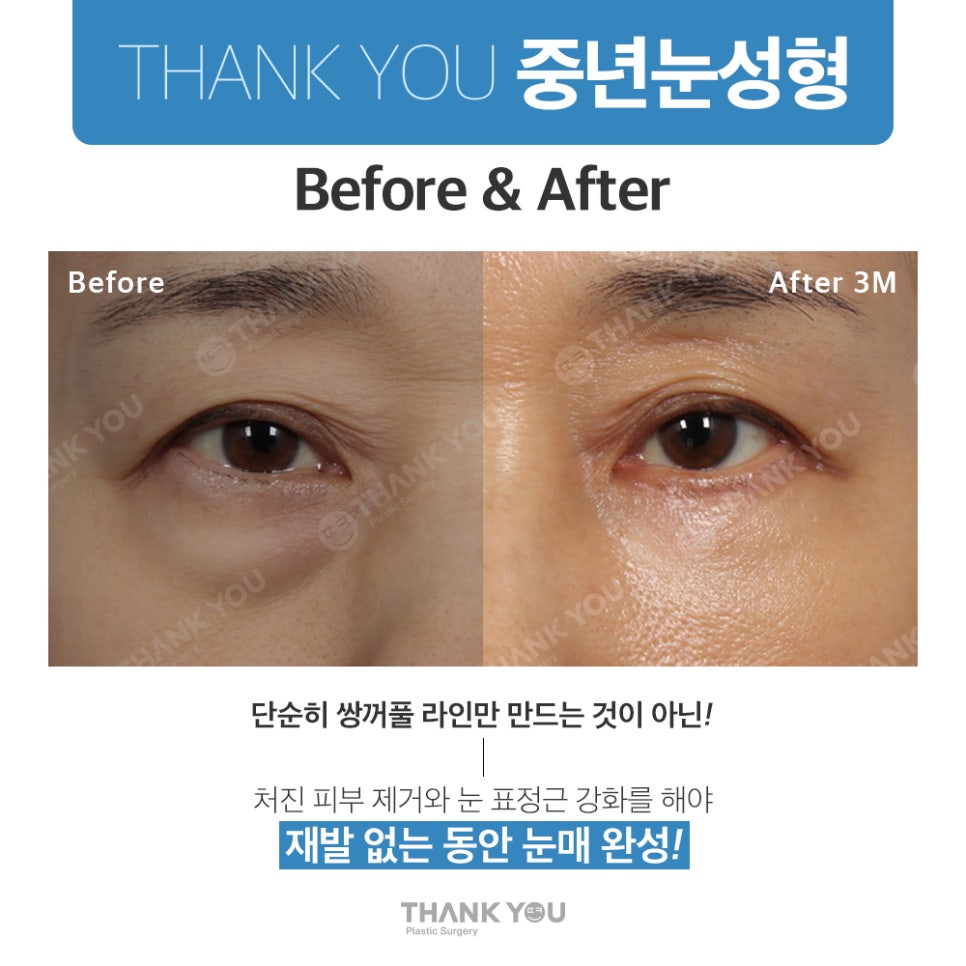 중년눈수술, 50대 60대 눈처짐과 눈꺼풀짓무름 해결법 관련 이미지 9