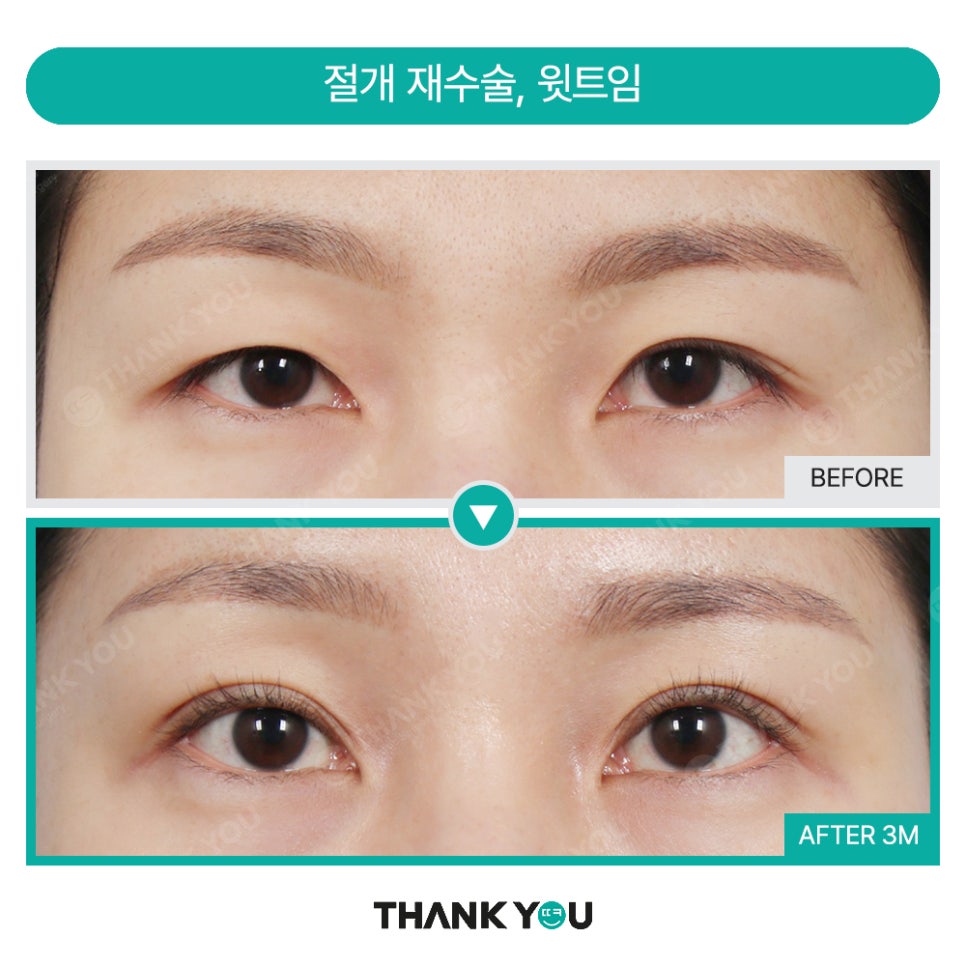 가로로 긴 눈은 어떤 쌍꺼풀라인이 어울릴까요? 관련 이미지 10