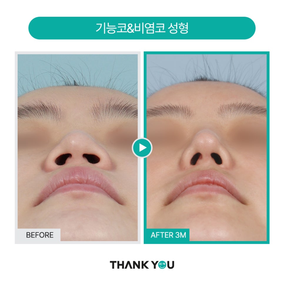 2분만에 막힌 코 뻥 뚫어주는 코블레이션 [ft.비염코성형 전후] 관련 이미지 22