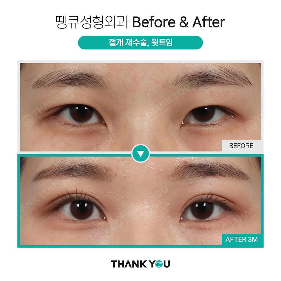 땡큐 절개쌍꺼풀 전후사진 (절개후 재수술 여부, NO?가능!) 관련 이미지 6