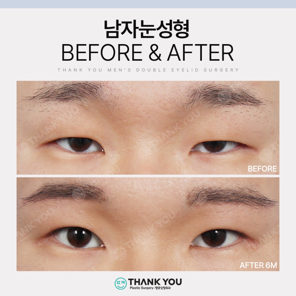 땡큐 남자눈성형 솔루션 (ft. 남자비절개 눈매교정 전후) 관련 이미지 11