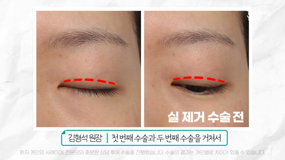 '쌍꺼풀 실 눈찌름'으로 안과? 쌍수실 제거+자연유착 라인 살리는 법 관련 이미지 4