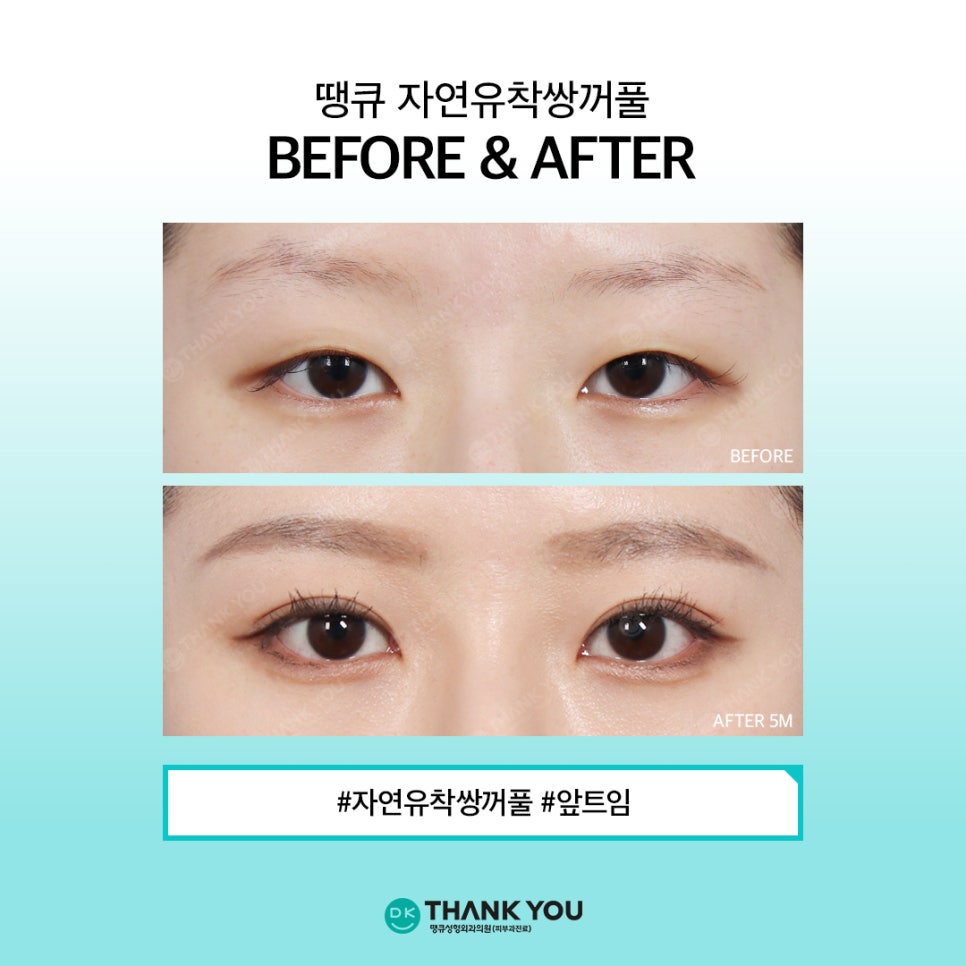 Natural Adhesion Double Eyelids: If You Want Naturalness That Lasts Longer image 10