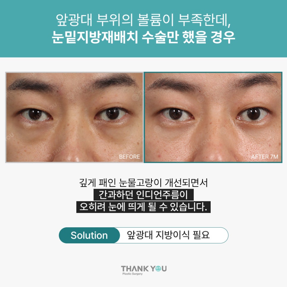 눈밑지방재배치 수술로도 볼륨이 부족한 경우엔? (ft. 앞광대 지방이식) 관련 이미지 5