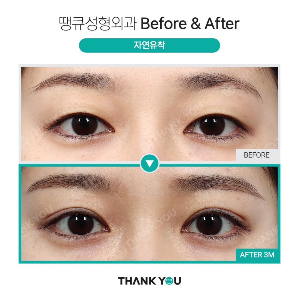 신논현역 성형외과에서 쌍수 전후 Check✨ 관련 이미지 2