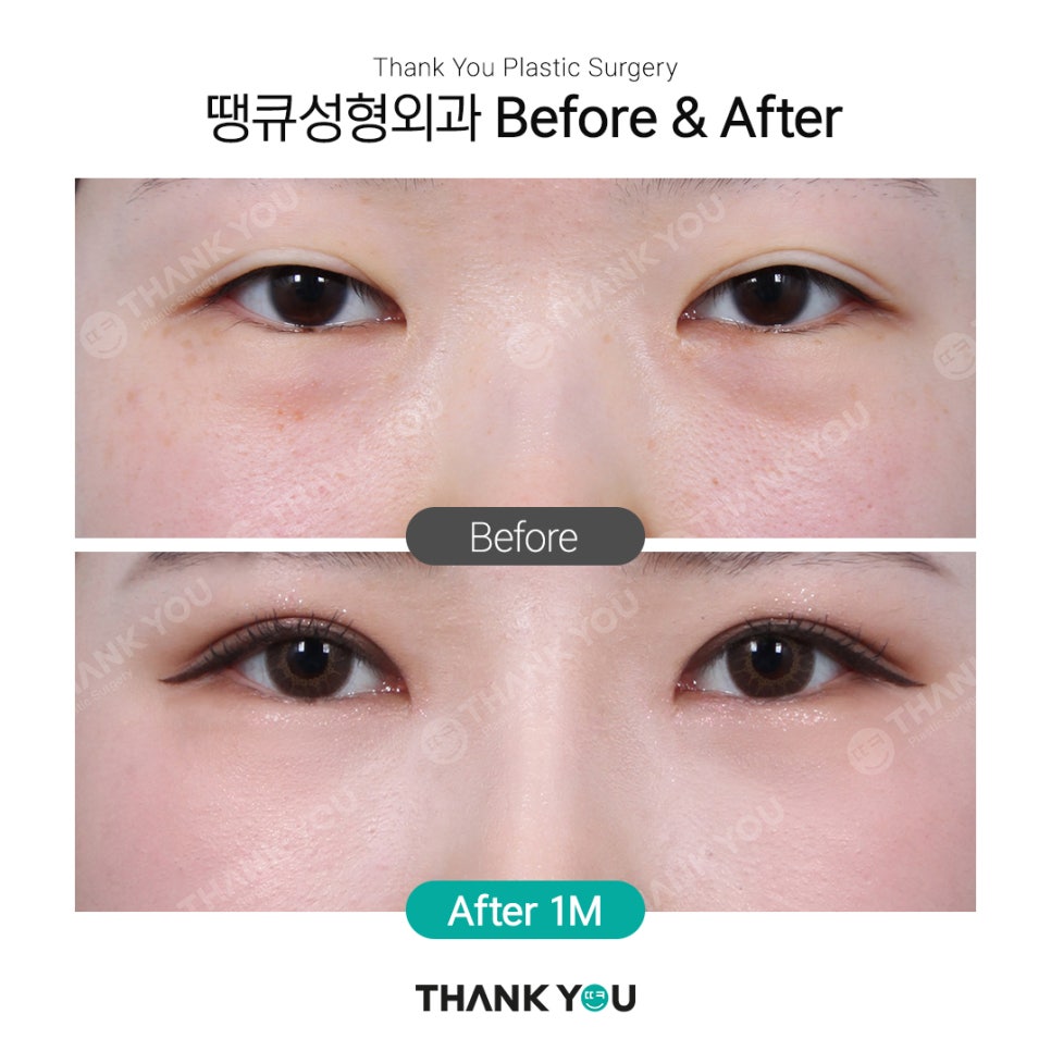 땡큐에서 알려드리는 눈밑지방재배치 Check point ❗ 관련 이미지 2