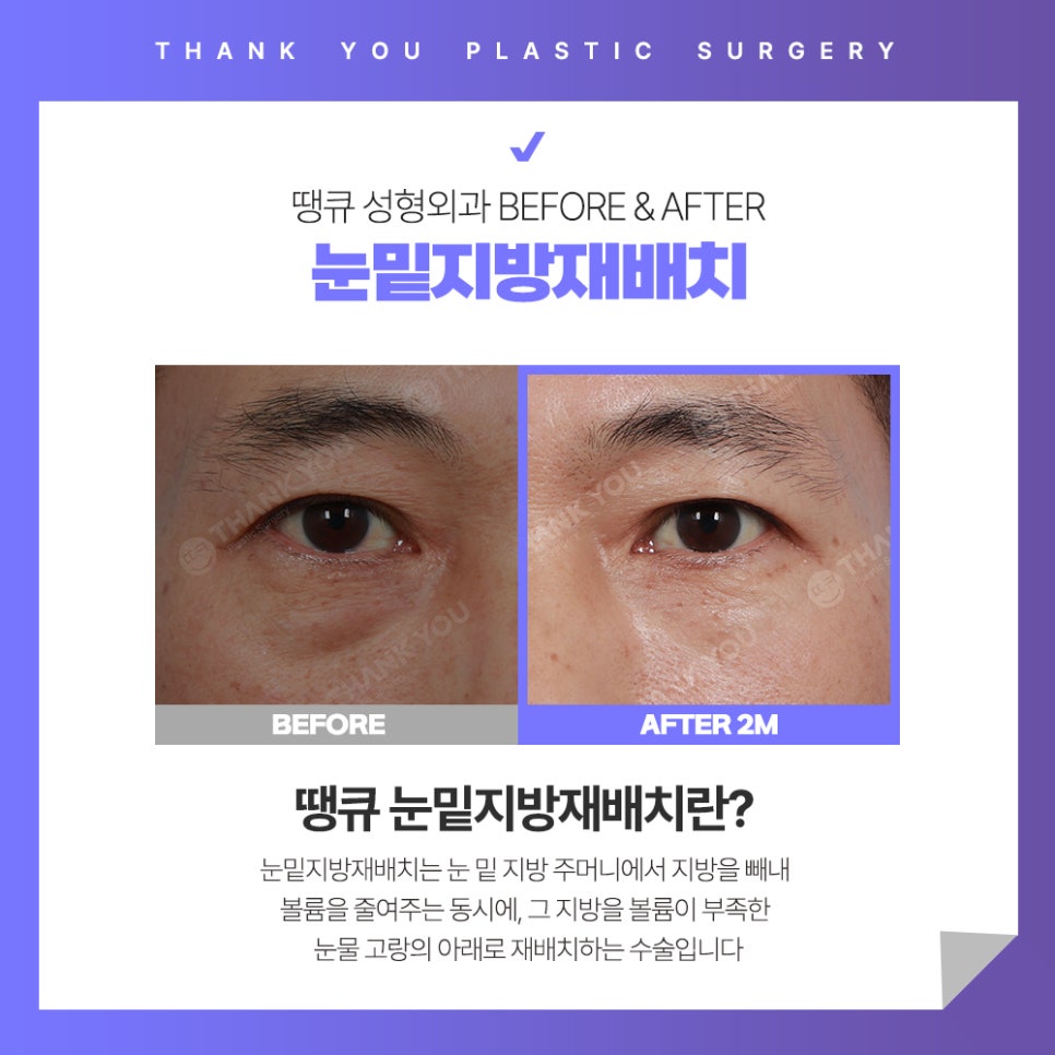 눈밑 불룩? 눈밑지방재배치 수술 후에도 재발할까? 관련 이미지 4