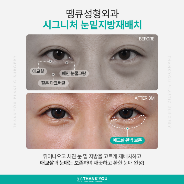 눈밑지방재배치잘하는곳은 이렇게 합니다✨✨ 관련 이미지 3