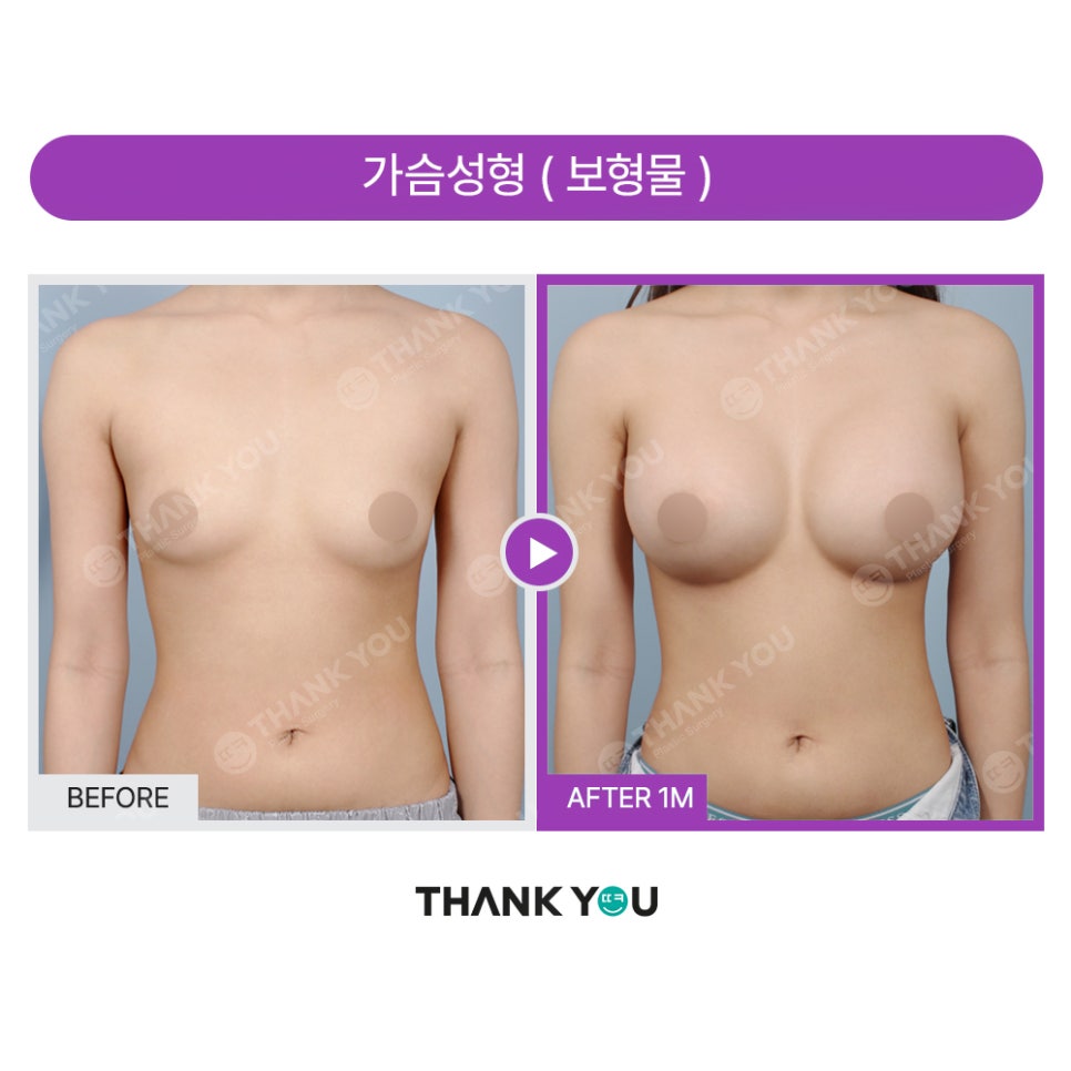 강남 가슴성형외과, 흉곽과 체형을 고려한 모티바보형물 관련 이미지 15