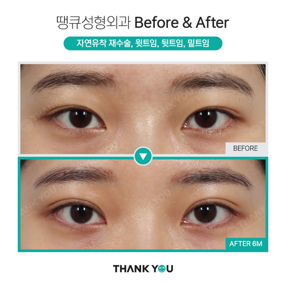 강남쌍수 절개눈매교정 전후와 트임성형 추천 POINT 관련 이미지 3