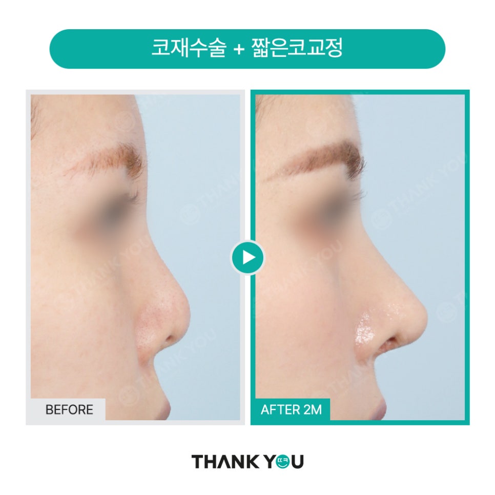 자가늑연골 코수술 장단점, 실리콘없이 무보형물 전후Check 관련 이미지 17