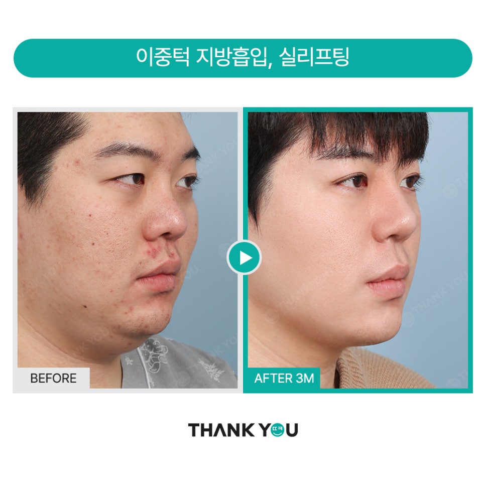 땡큐 맥미남, 뮤지컬배우 남자 복부지방흡입 전후 Check 관련 이미지 13