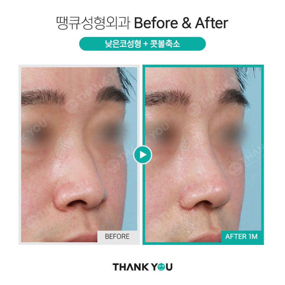코 재수술시 기존 실리콘은 꼭 제거해야 되나요? 관련 이미지 6
