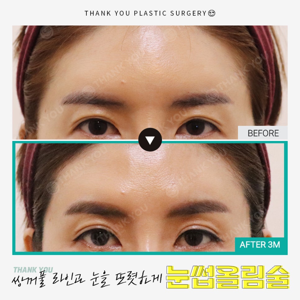 쌍수에 눈썹올림술을 추천하는 이유?! 관련 이미지 16