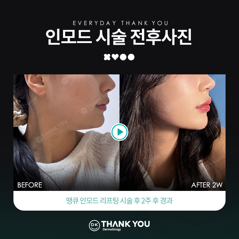땡큐피부과 인모드 리프팅 EVENT ✨ 관련 이미지 3