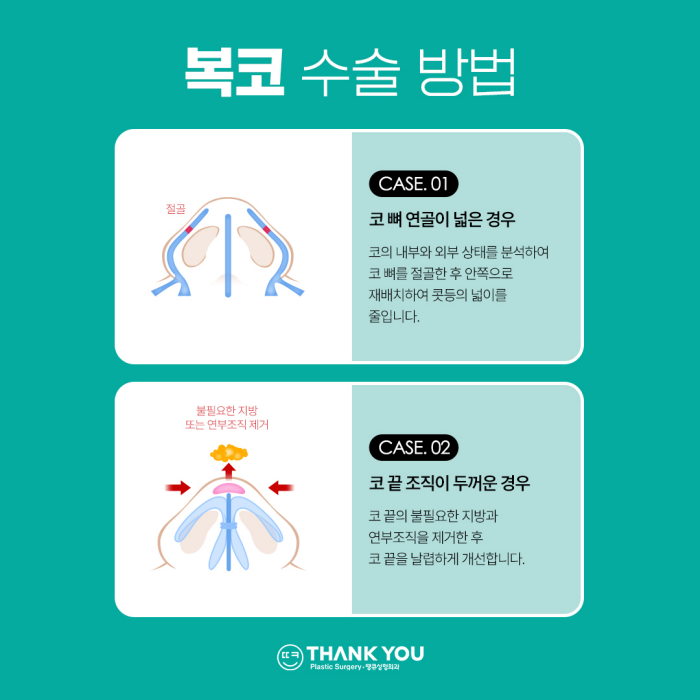 복코성형, 꼭 코뼈절골을 해야할까요? 관련 이미지 4