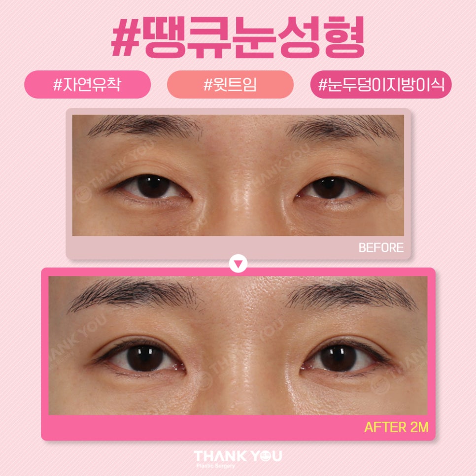 땡큐 쌍꺼풀 전후사진 비교 Before & After 관련 이미지 6