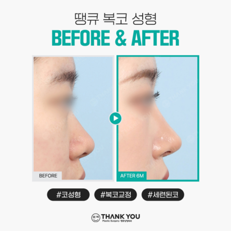 복코성형, 꼭 코뼈절골을 해야할까요? 관련 이미지 11