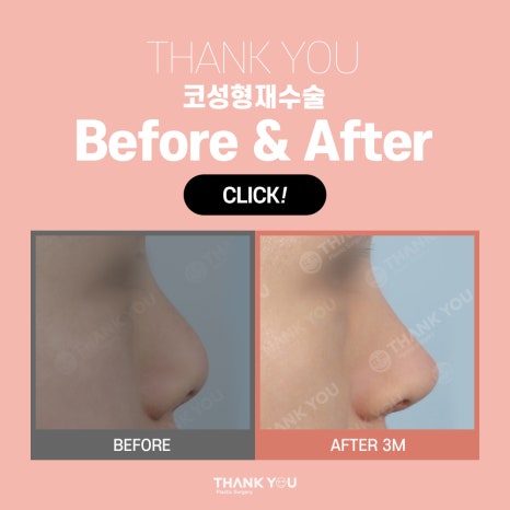 코성형 재수술 비용이 더 비싼 이유는?(수술이 더 어려운 이유) 관련 이미지 12
