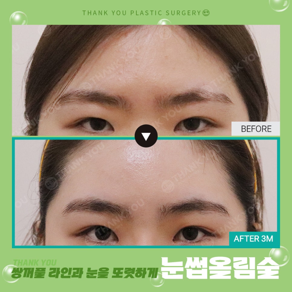 쌍수에 눈썹올림술을 추천하는 이유?! 관련 이미지 20