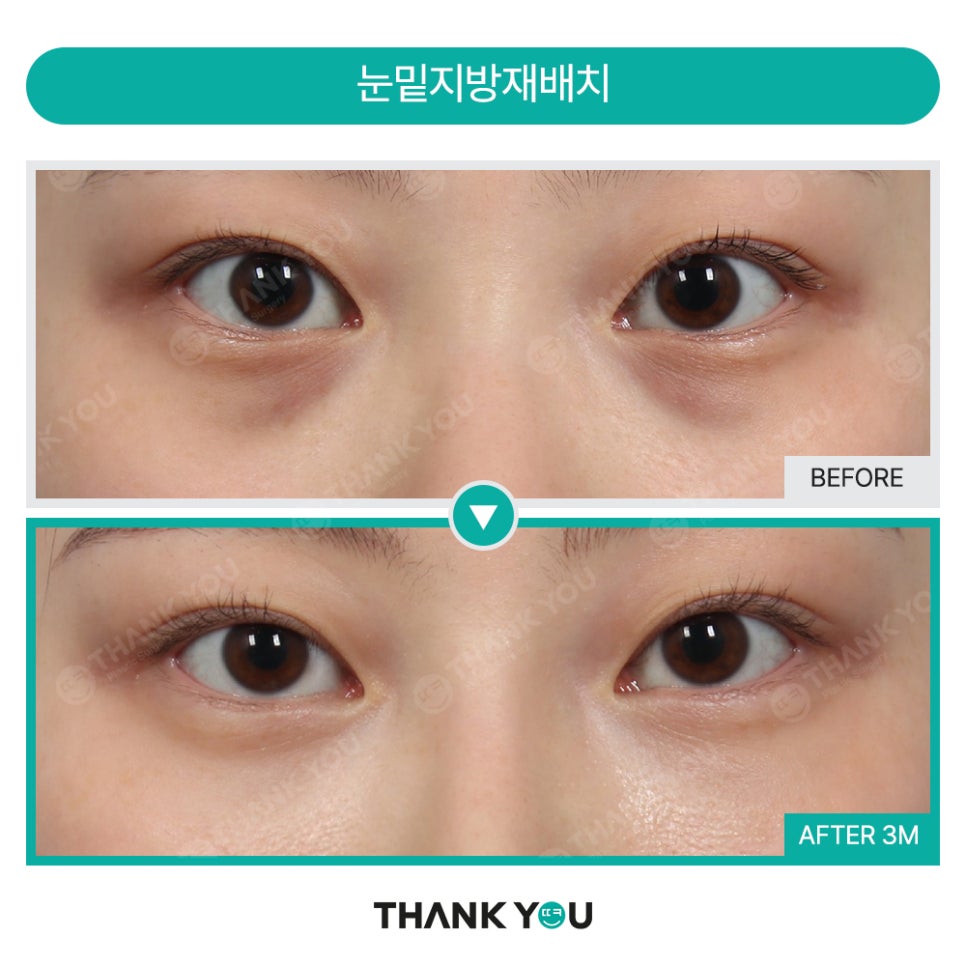 눈밑 수술, 혈류 보존이란? 관련 이미지 9