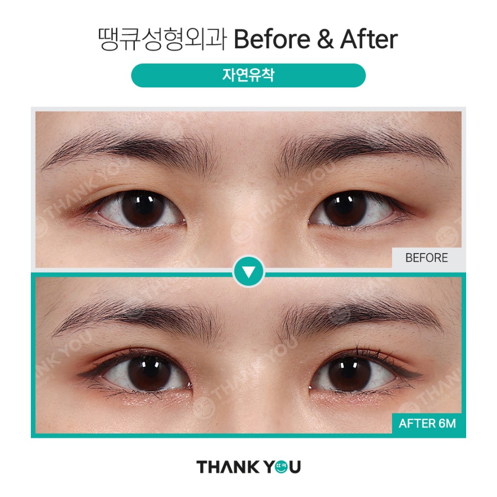 신논현역 성형외과에서 쌍수 전후 Check✨ 관련 이미지 3