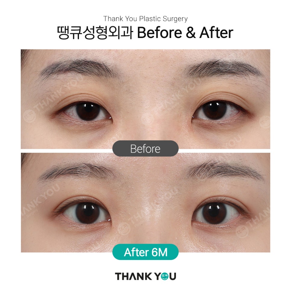 쌍꺼풀 라인 종류, 인아웃+세미아웃라인 Before After 관련 이미지 5