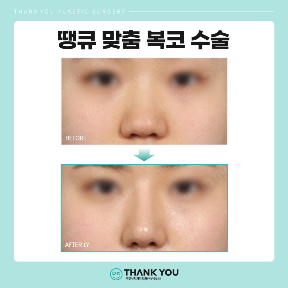 복코수술후기? 세련된 이미지 만드는 땡큐에서 확인! 관련 이미지 6